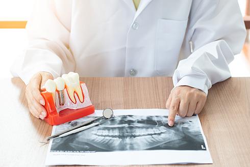 Benefícios do implante dentário: mais autoestima e qualidade de vida